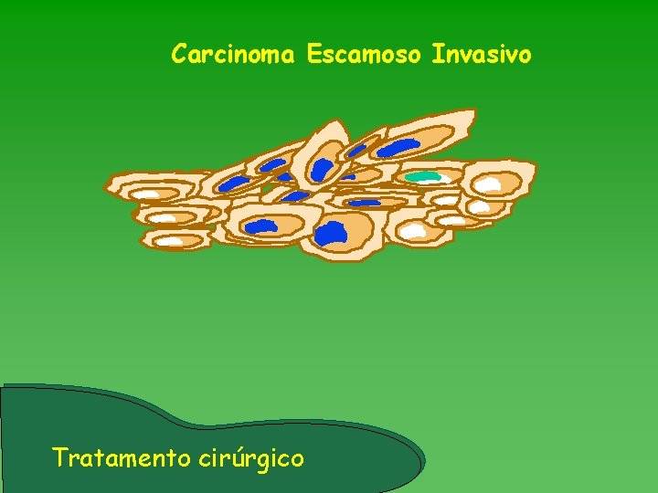 Carcinoma Escamoso Invasivo Tratamento cirúrgico 