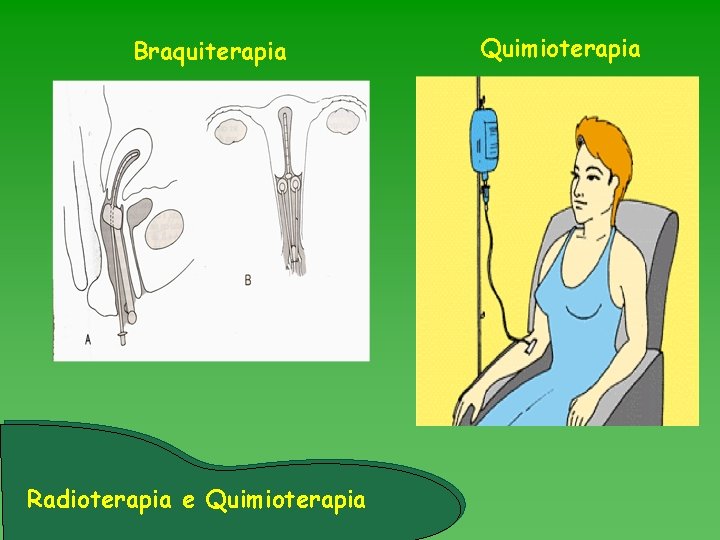 Braquiterapia Radioterapia e Quimioterapia 