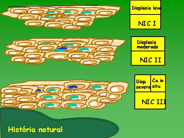 Displasia leve NIC I Displasia moderada NIC II Disp. Ca. in severa situ NIC