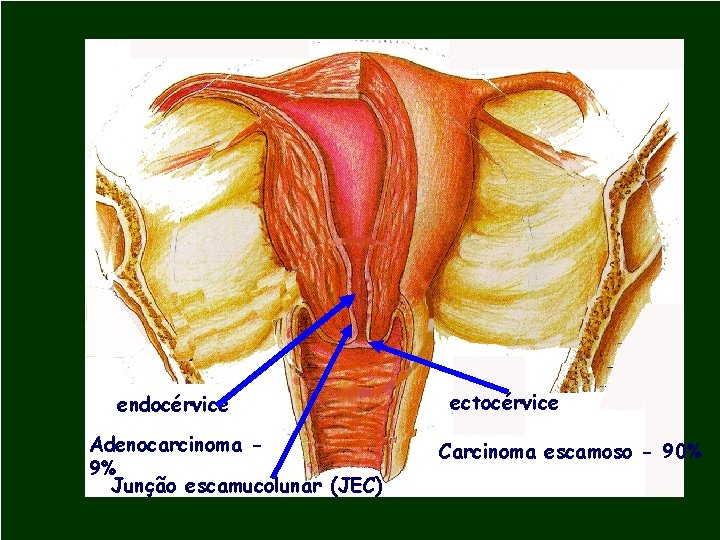 endocérvice Adenocarcinoma 9% Junção escamucolunar (JEC) ectocérvice Carcinoma escamoso - 90% 