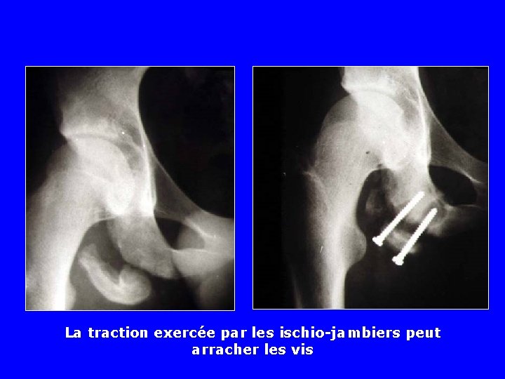 La traction exercée par les ischio-jambiers peut arracher les vis La traction exercée par les ischio-jambiers peut arracher les vis