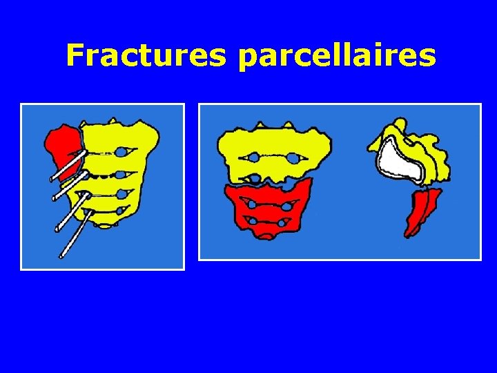 Fractures parcellaires 