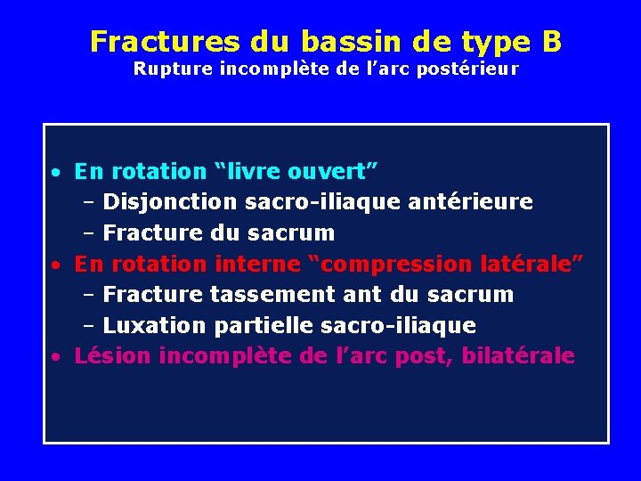 Fractures du bassin de type B Rupture incomplète de l’arc postérieur • En rotation Fractures du bassin de type B Rupture incomplète de l’arc postérieur • En rotation