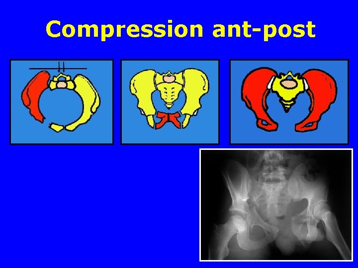 Compression ant-post Compression ant-post