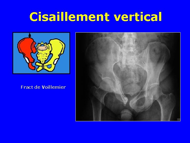 Cisaillement vertical Fract de Voillemier 