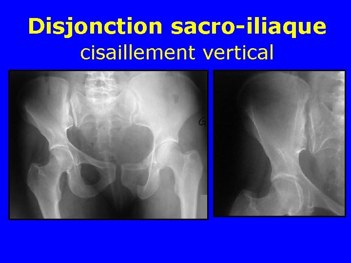 Disjonction sacro-iliaque cisaillement vertical 