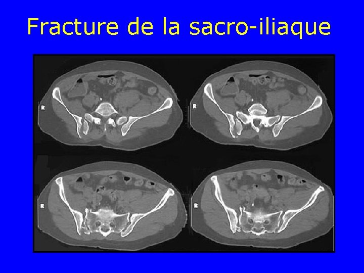 Fracture de la sacro-iliaque 