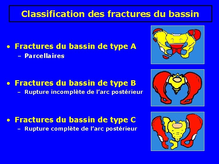Classification des fractures du bassin • Fractures du bassin de type A – Parcellaires Classification des fractures du bassin • Fractures du bassin de type A – Parcellaires
