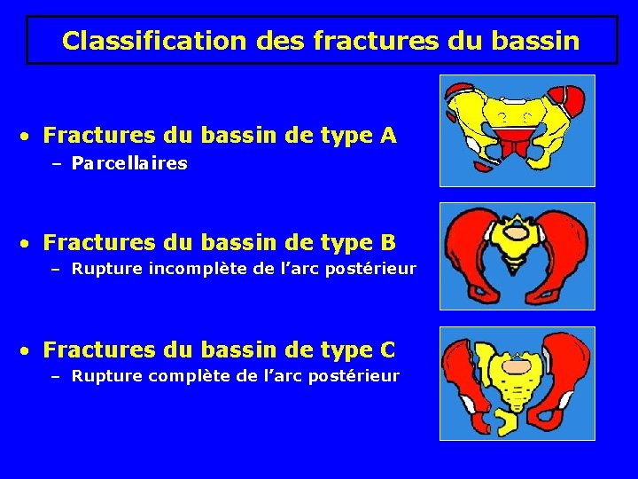 Classification des fractures du bassin • Fractures du bassin de type A – Parcellaires