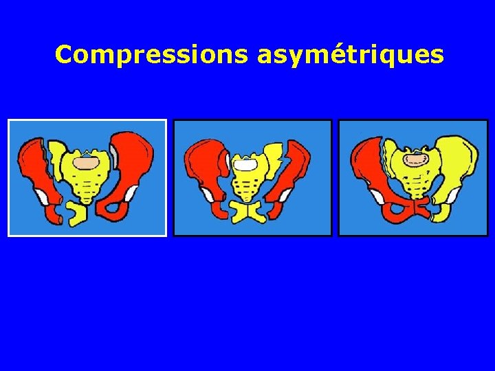 Compressions asymétriques Compressions asymétriques