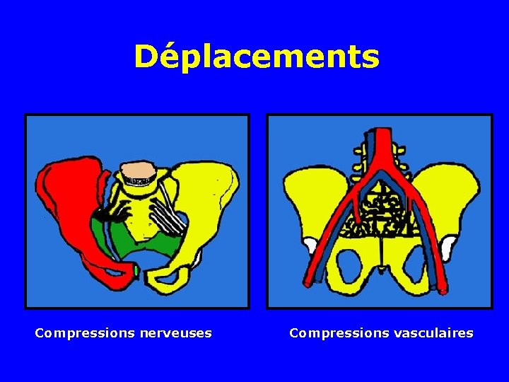 Déplacements Compressions nerveuses Compressions vasculaires Déplacements Compressions nerveuses Compressions vasculaires