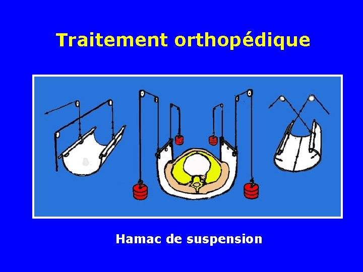 Traitement orthopédique Hamac de suspension Traitement orthopédique Hamac de suspension