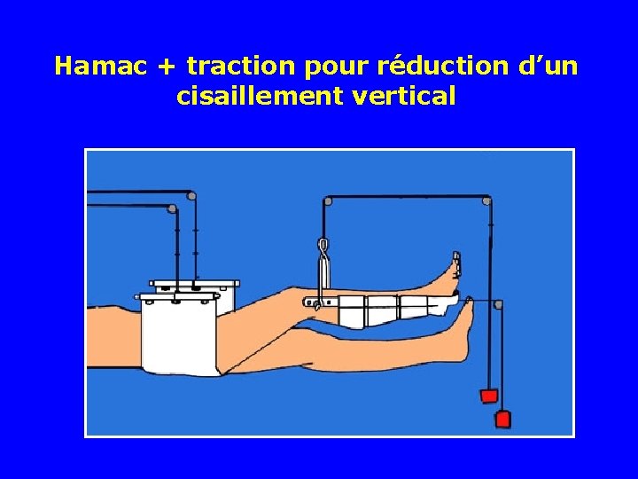 Hamac + traction pour réduction d’un cisaillement vertical Hamac + traction pour réduction d’un cisaillement vertical
