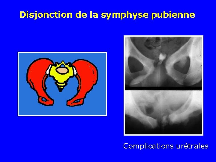 Disjonction de la symphyse pubienne Complications urétrales 