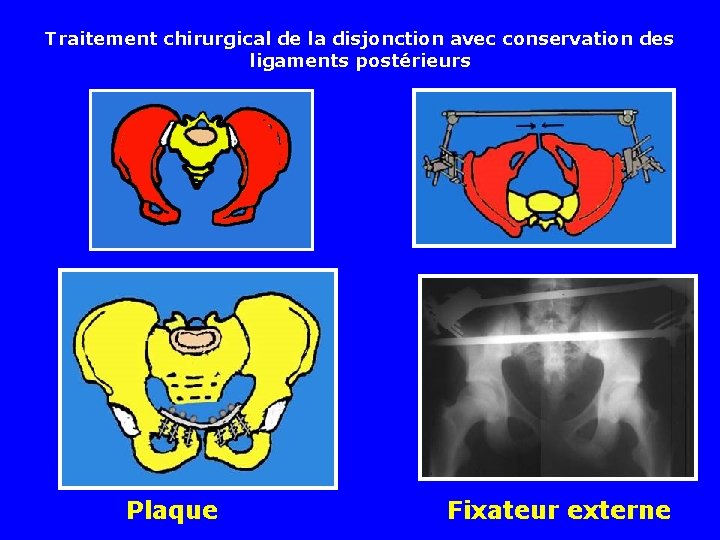 Traitement chirurgical de la disjonction avec conservation des ligaments postérieurs Plaque Fixateur externe 