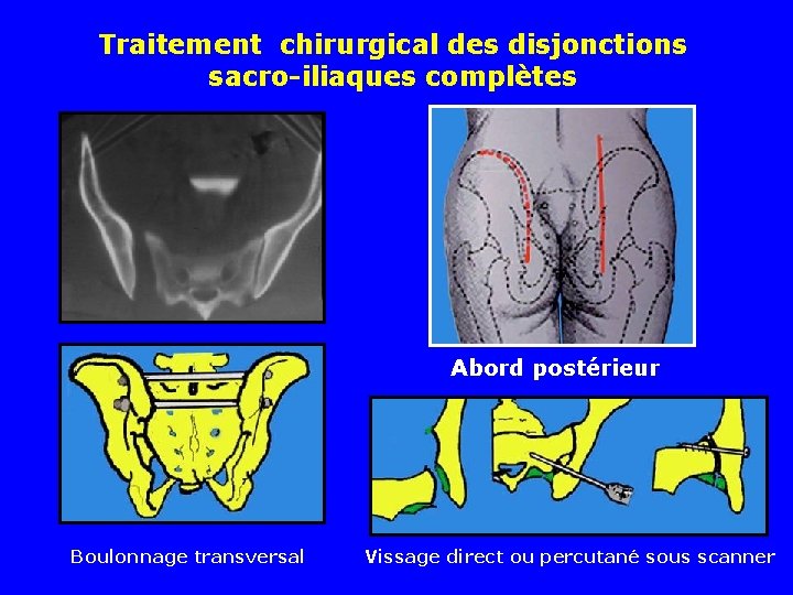 Traitement chirurgical des disjonctions sacro-iliaques complètes Abord postérieur Boulonnage transversal Vissage direct ou percutané Traitement chirurgical des disjonctions sacro-iliaques complètes Abord postérieur Boulonnage transversal Vissage direct ou percutané