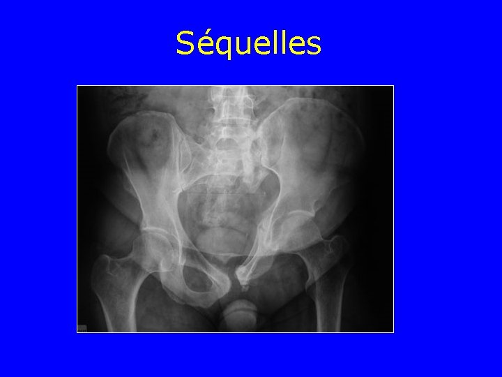 Séquelles Séquelles