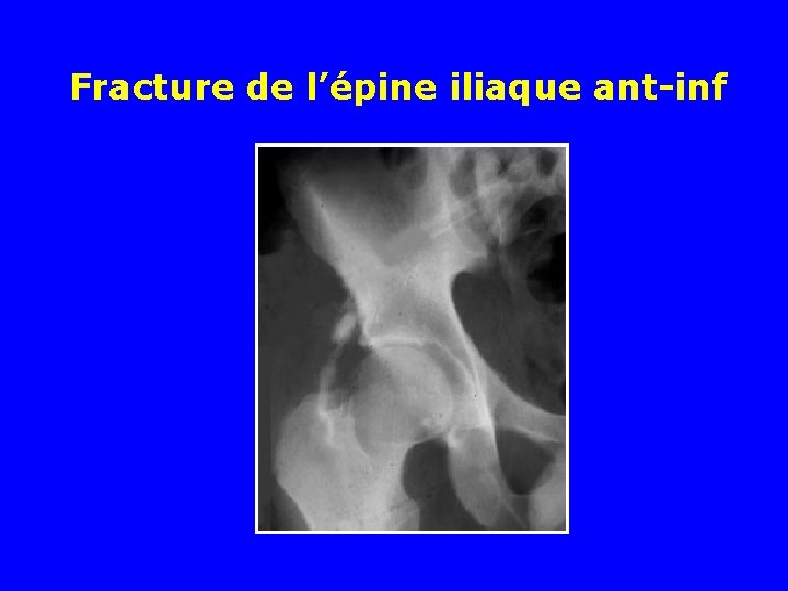 Fracture de l’épine iliaque ant-inf Fracture de l’épine iliaque ant-inf