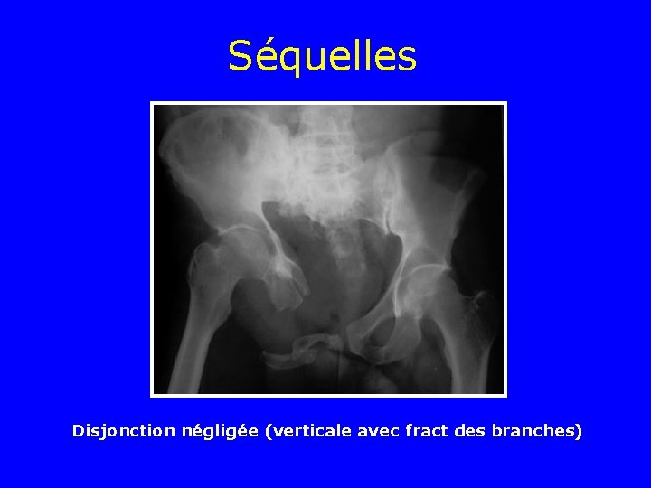 Séquelles Disjonction négligée (verticale avec fract des branches) Séquelles Disjonction négligée (verticale avec fract des branches)