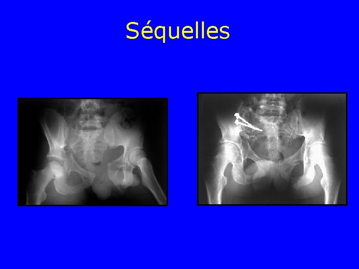 Séquelles Séquelles