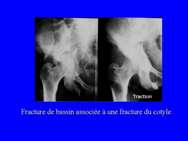 Traction Fracture de bassin associée à une fracture du cotyle 