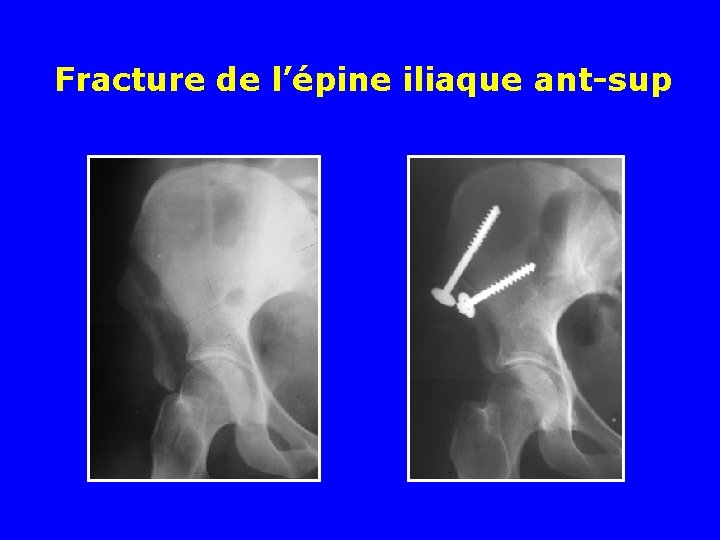 Fracture de l’épine iliaque ant-sup 