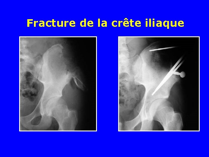 Fracture de la crête iliaque Fracture de la crête iliaque