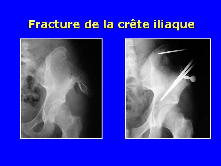 Fracture de la crête iliaque 