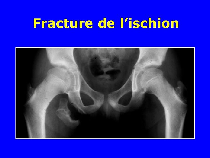 Fracture de l’ischion 