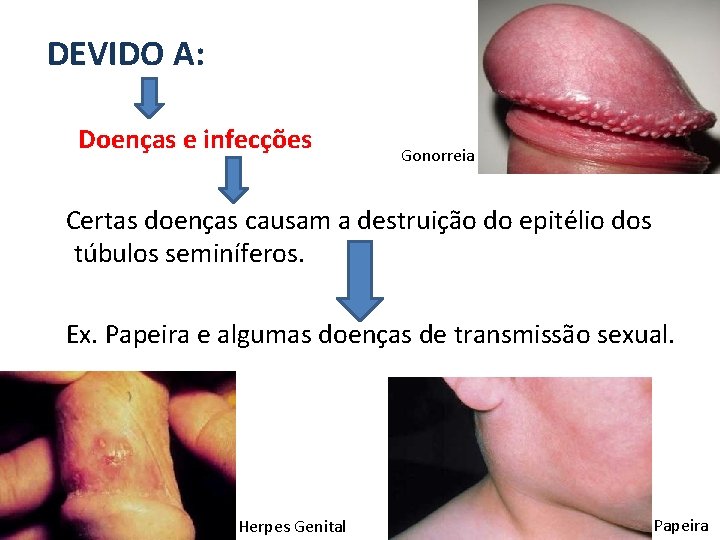 DEVIDO A: Doenças e infecções Gonorreia Certas doenças causam a destruição do epitélio dos
