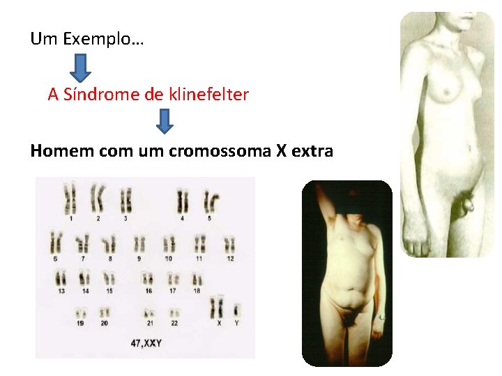 Um Exemplo… A Síndrome de klinefelter Homem com um cromossoma X extra 