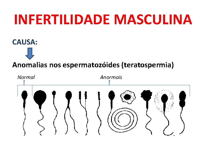 INFERTILIDADE MASCULINA CAUSA: Anomalias nos espermatozóides (teratospermia) Normal Anormais 