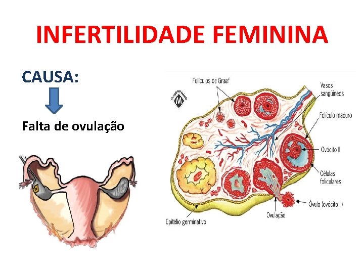 INFERTILIDADE FEMININA CAUSA: Falta de ovulação 
