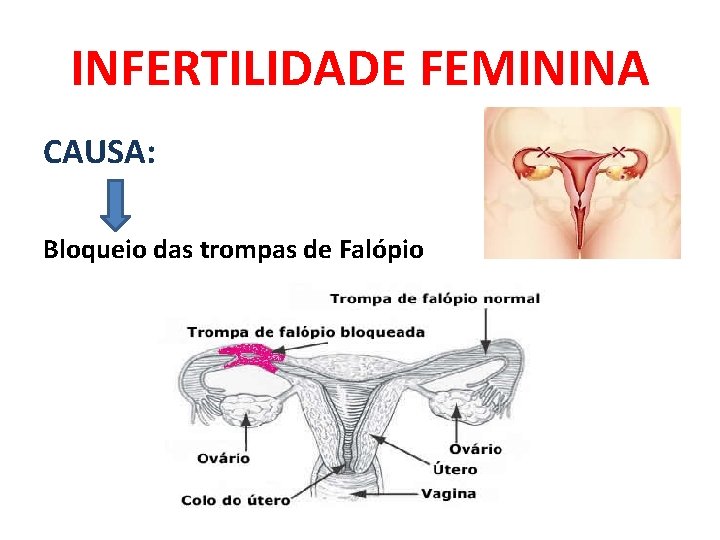 INFERTILIDADE FEMININA CAUSA: Bloqueio das trompas de Falópio 