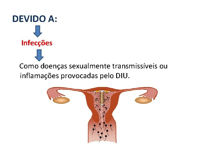 DEVIDO A: Infecções Como doenças sexualmente transmissíveis ou inflamações provocadas pelo DIU. 