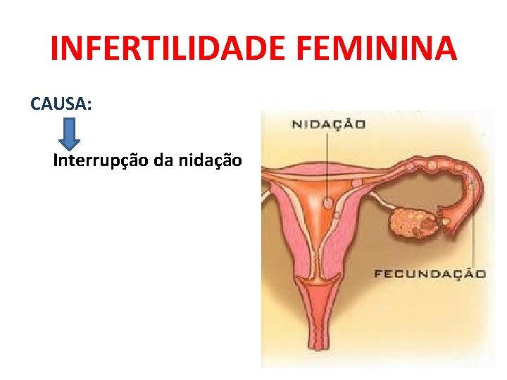 INFERTILIDADE FEMININA CAUSA: Interrupção da nidação 