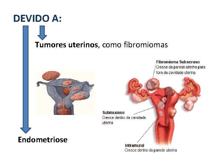 DEVIDO A: Tumores uterinos, como fibromiomas Endometriose 