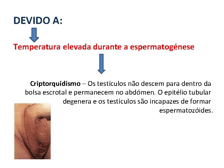 DEVIDO A: Temperatura elevada durante a espermatogénese Criptorquidismo – Os testículos não descem para