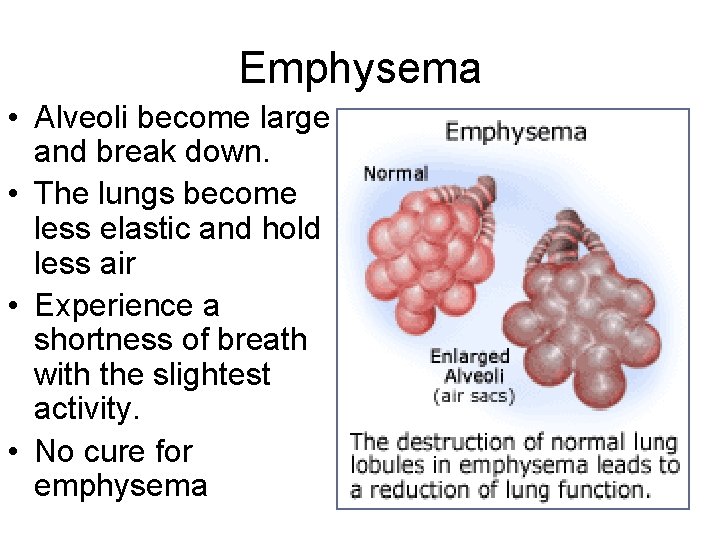 Emphysema • Alveoli become large and break down. • The lungs become less elastic