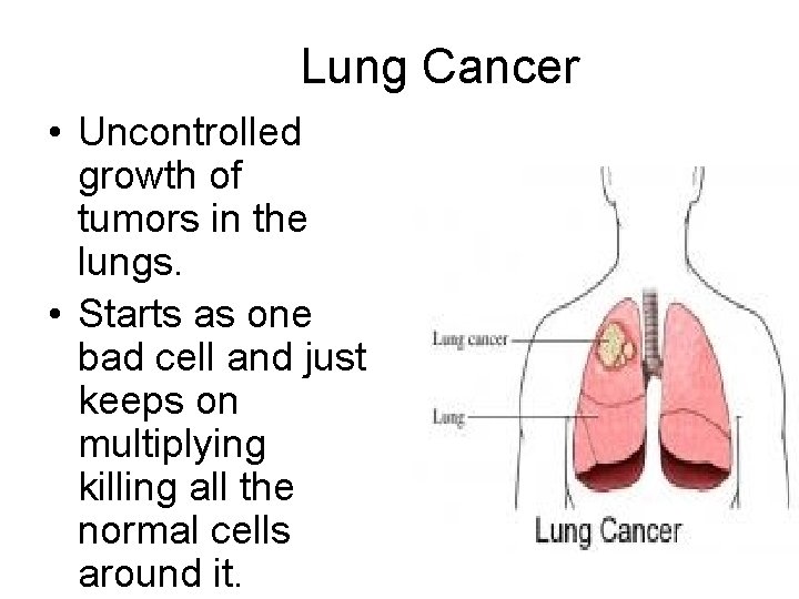 Lung Cancer • Uncontrolled growth of tumors in the lungs. • Starts as one