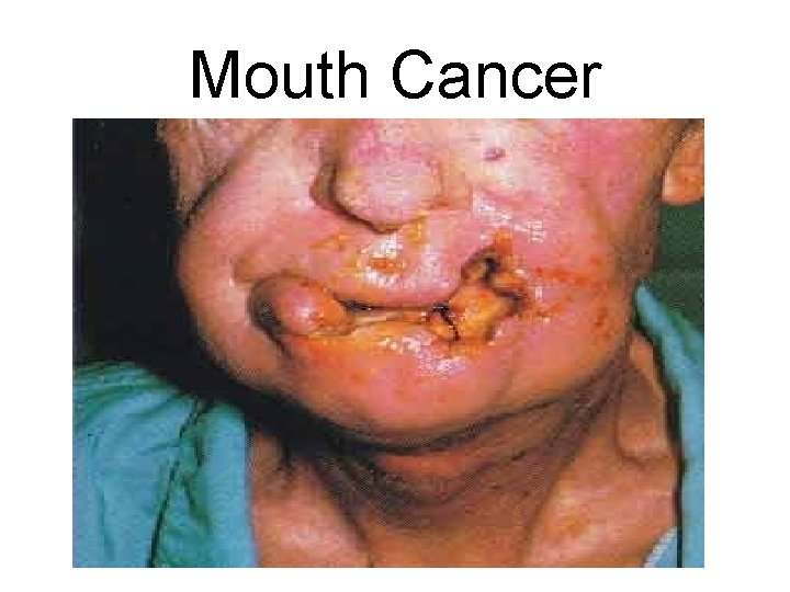 Mouth Cancer 