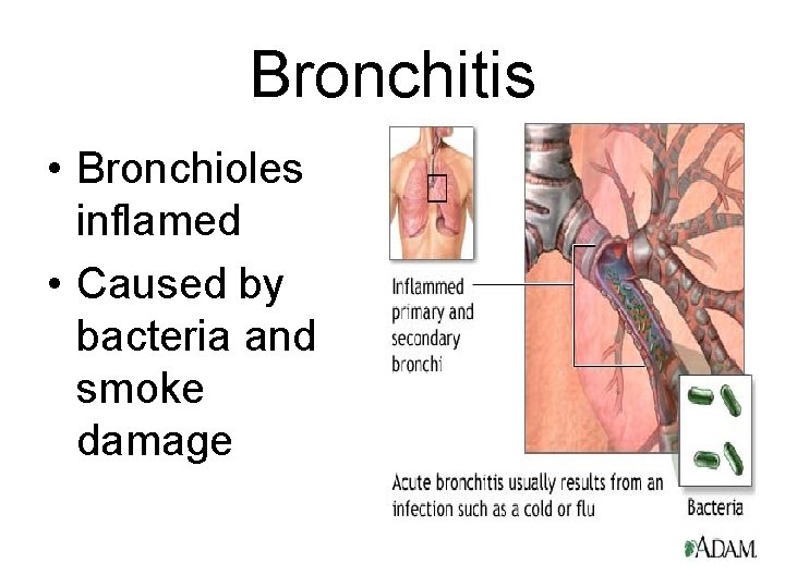 Bronchitis • Bronchioles inflamed • Caused by bacteria and smoke damage 