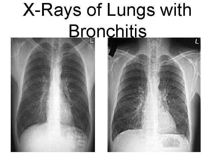 X-Rays of Lungs with Bronchitis 