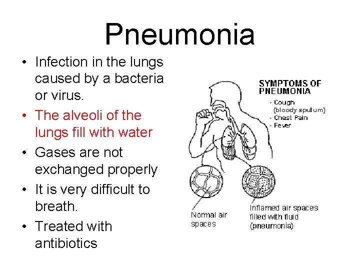 Pneumonia • Infection in the lungs caused by a bacteria or virus. • The