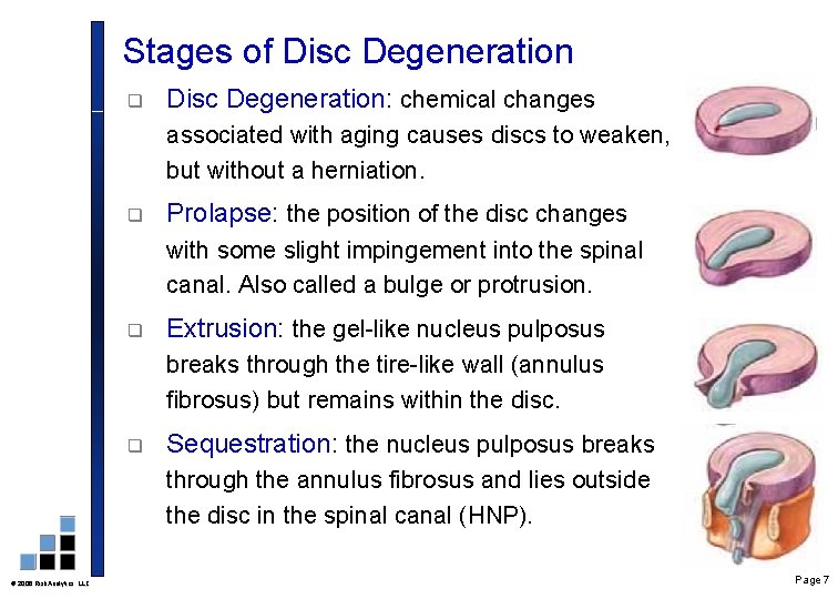 Stages of Disc Degeneration q Disc Degeneration: chemical changes associated with aging causes discs