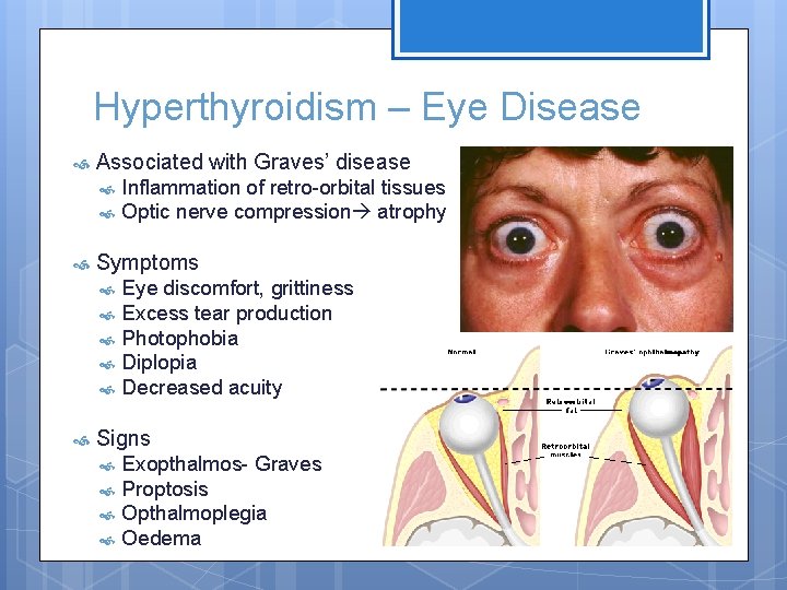 Hyperthyroidism – Eye Disease Associated with Graves’ disease Symptoms Inflammation of retro-orbital tissues Optic