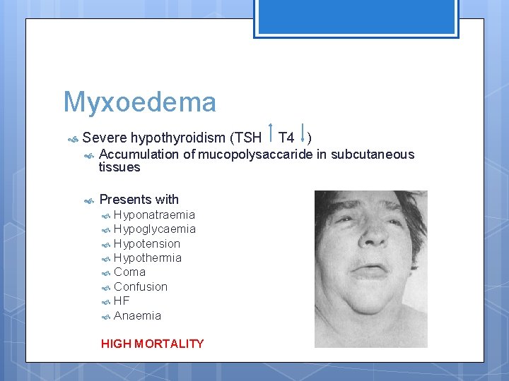 Myxoedema Severe hypothyroidism (TSH T 4 ) Accumulation of mucopolysaccaride in subcutaneous tissues Presents