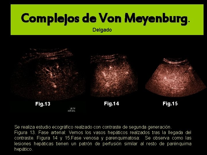 Complejos de Von Meyenburg. Delgado Fig. 13 Fig. 14 Fig. 15 Se realiza estudio