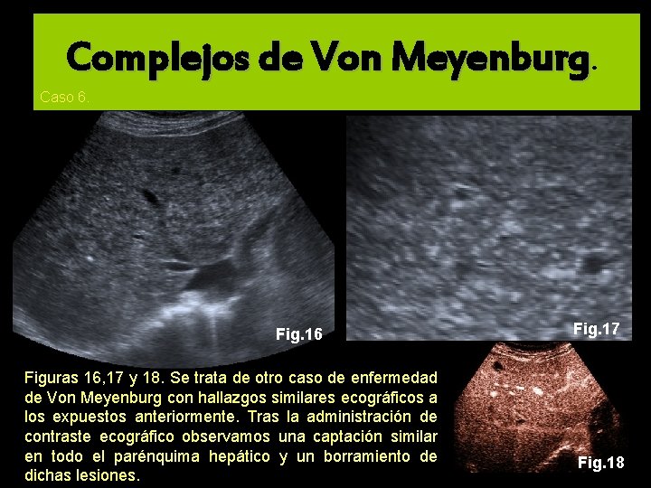 Complejos de Von Meyenburg. Caso 6. Fig. 16 Figuras 16, 17 y 18. Se