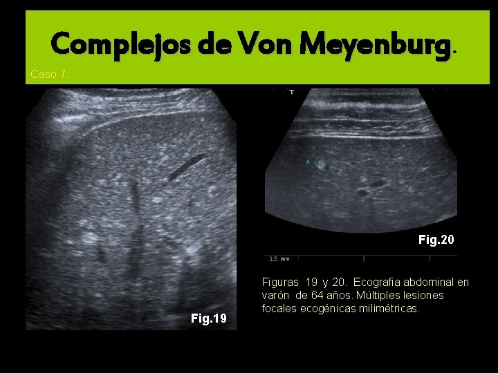 Complejos de Von Meyenburg. Caso 7. Fig. 20 Fig. 19 Figuras 19 y 20.